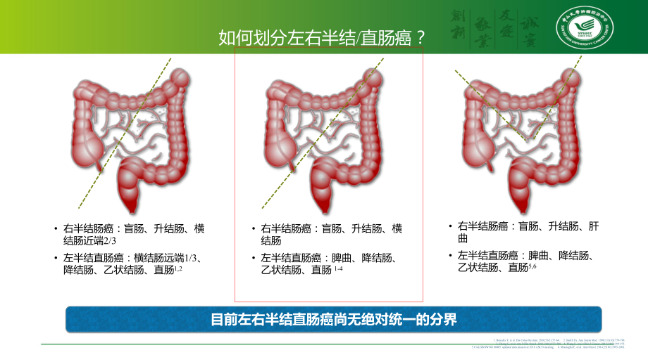 左右半结直肠癌的区别课件.ppt_第3页