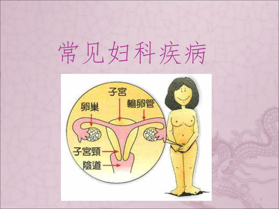 常见妇科疾病课件.ppt_第1页