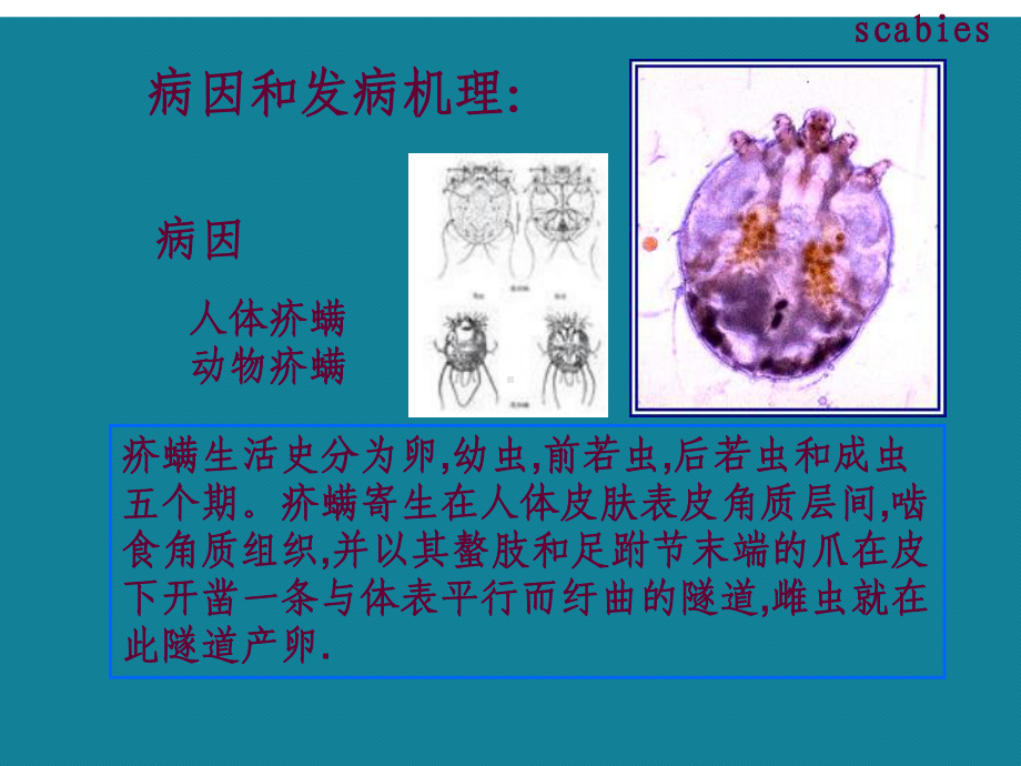 疥疮、神经性皮炎、瘙痒症课件.ppt_第3页