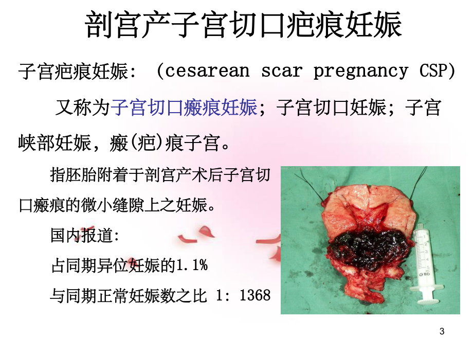 疤痕妊娠的影像学诊断课件.ppt_第3页