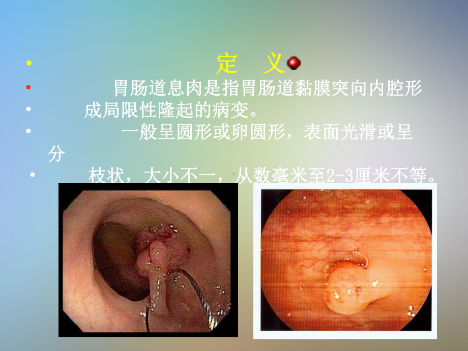 胃肠道息肉内镜下电凝切除术课件.pptx_第2页