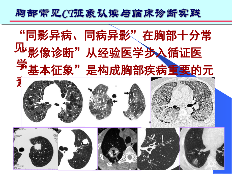 肺部十大征象诊断应用完整版课件.ppt_第2页