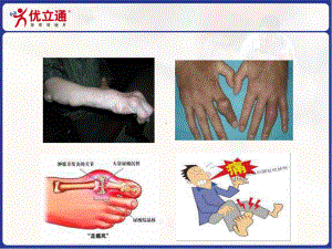 高尿酸血症 优立通课件.ppt