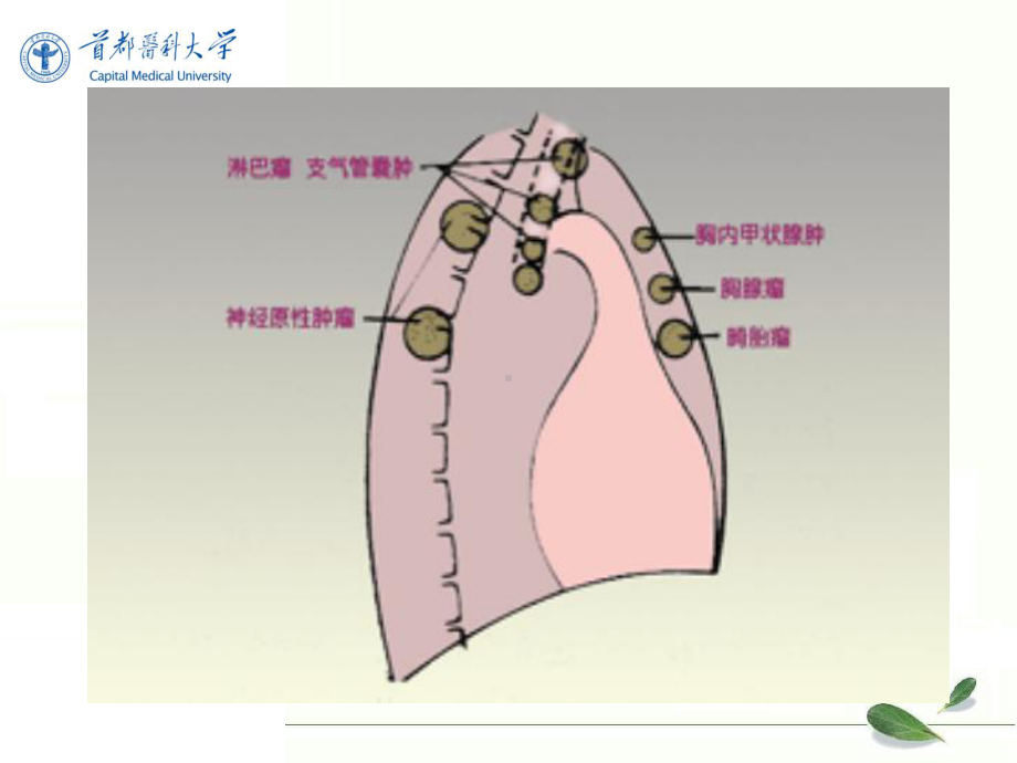 《影像诊断学》教学课件：第七节-纵膈肿瘤.ppt_第3页