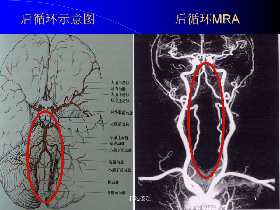 [新版]后循环缺血课件.ppt_第3页