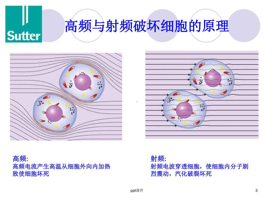 Sutter低温射频刀介绍课件.ppt_第3页