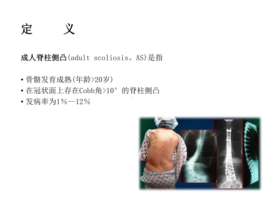 退变性成人脊柱侧凸课件.ppt_第3页