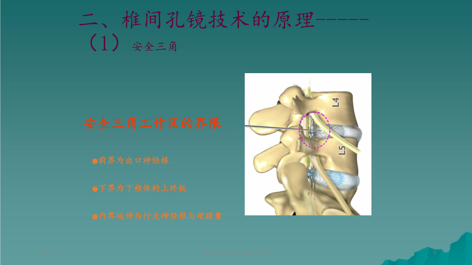 椎间孔镜技术介绍课件.ppt_第3页