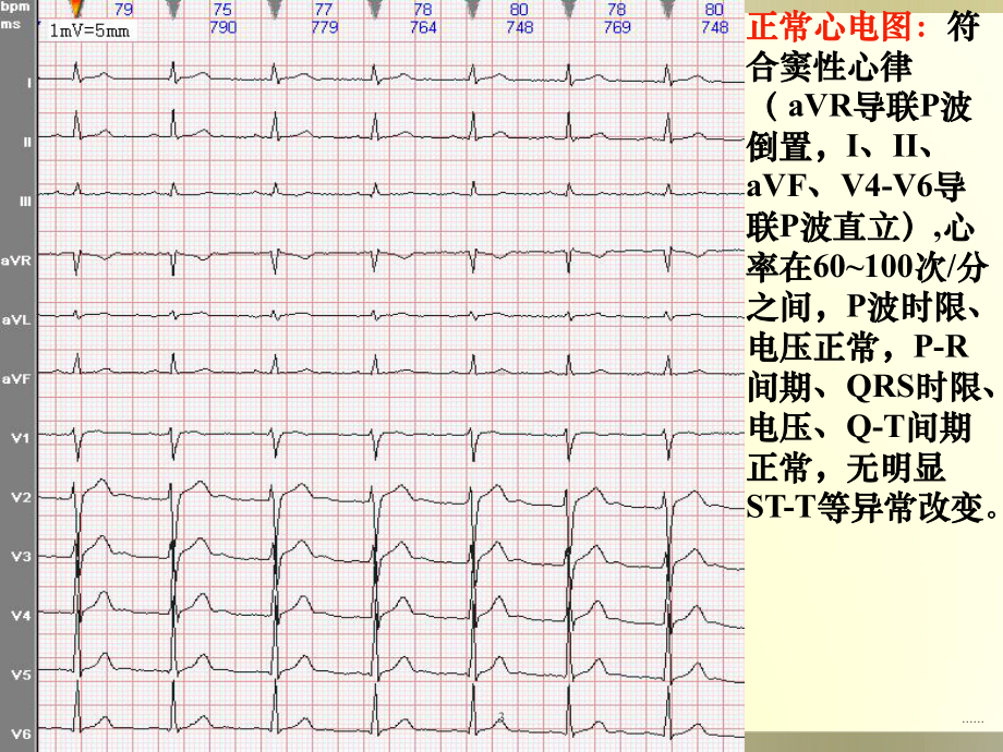 图解常见心电图诊断全面课件.ppt_第3页