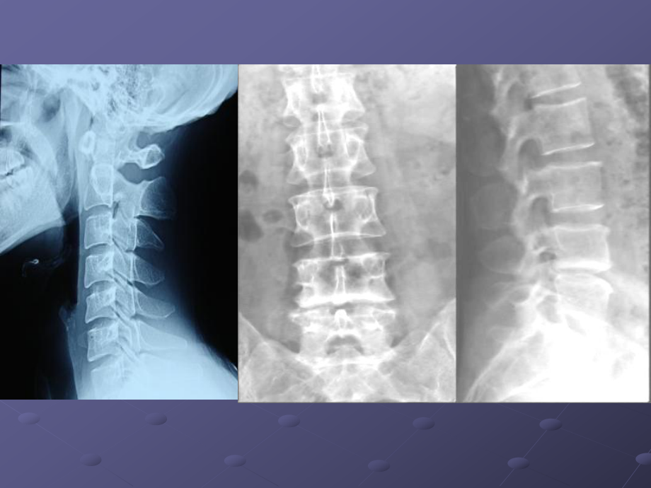 常见脊柱疾病影像学课件.ppt_第3页