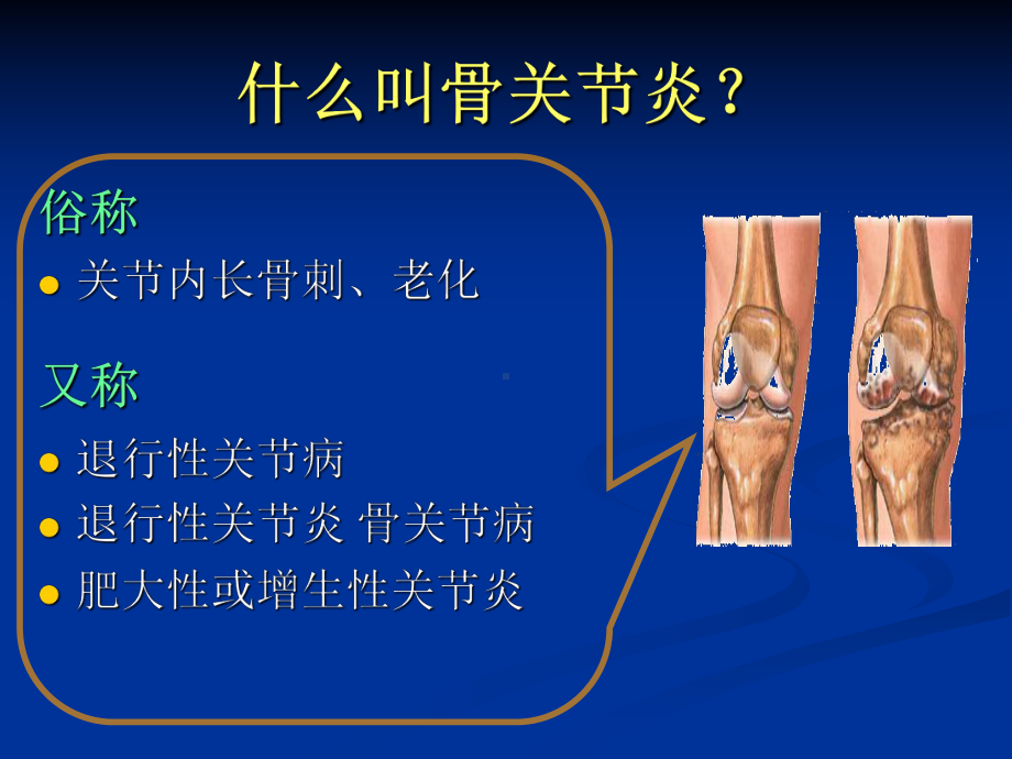 膝关节OA分级治疗课件.ppt_第2页