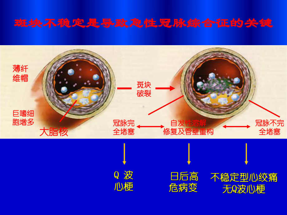 最新急性心肌梗死课件.ppt_第2页