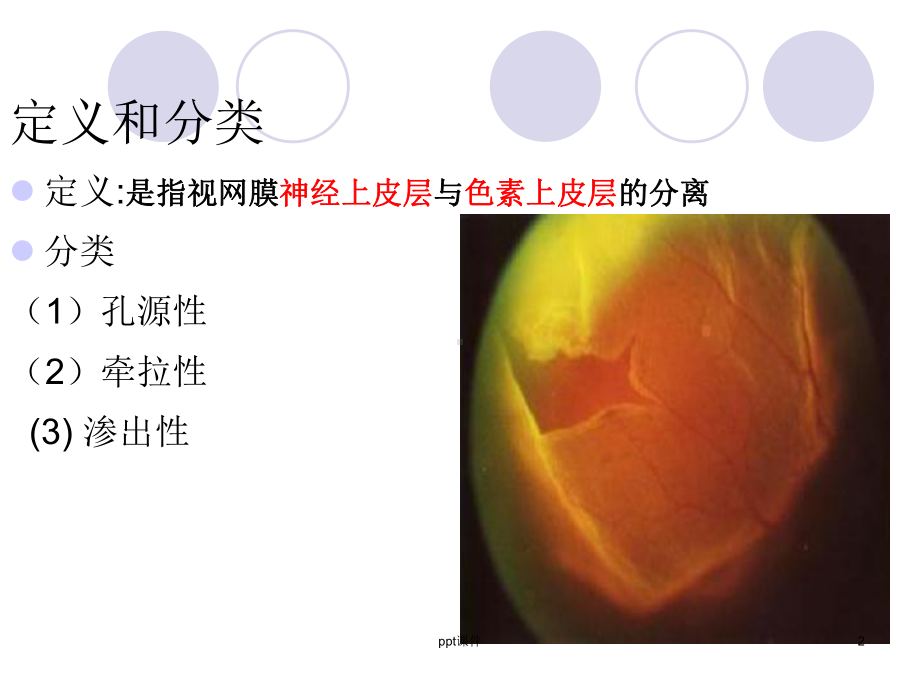 视网膜脱离课件.ppt_第2页