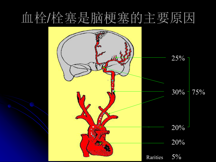 脑梗死抗凝治疗解读课件.ppt_第2页