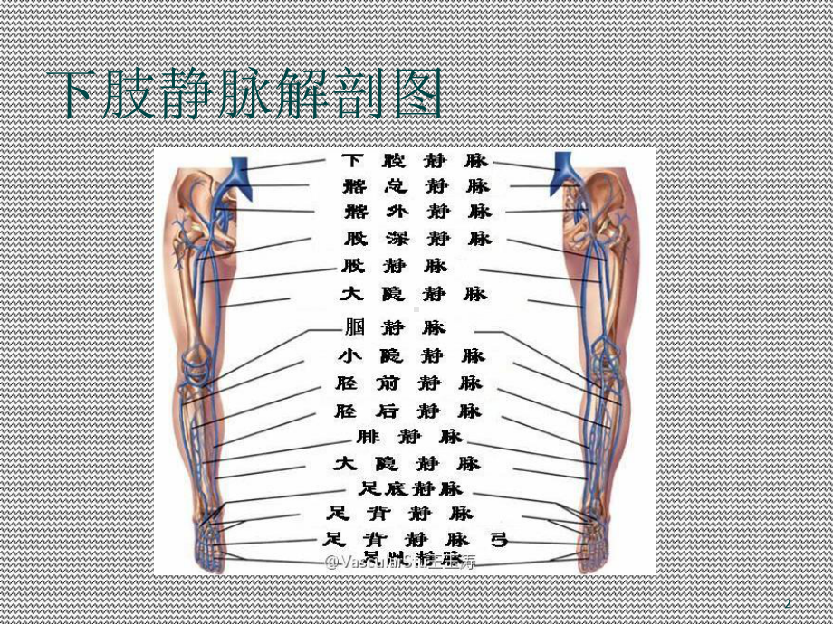 下肢深静脉血栓形成介入治疗规范的专家共识(课堂)课件.ppt_第2页