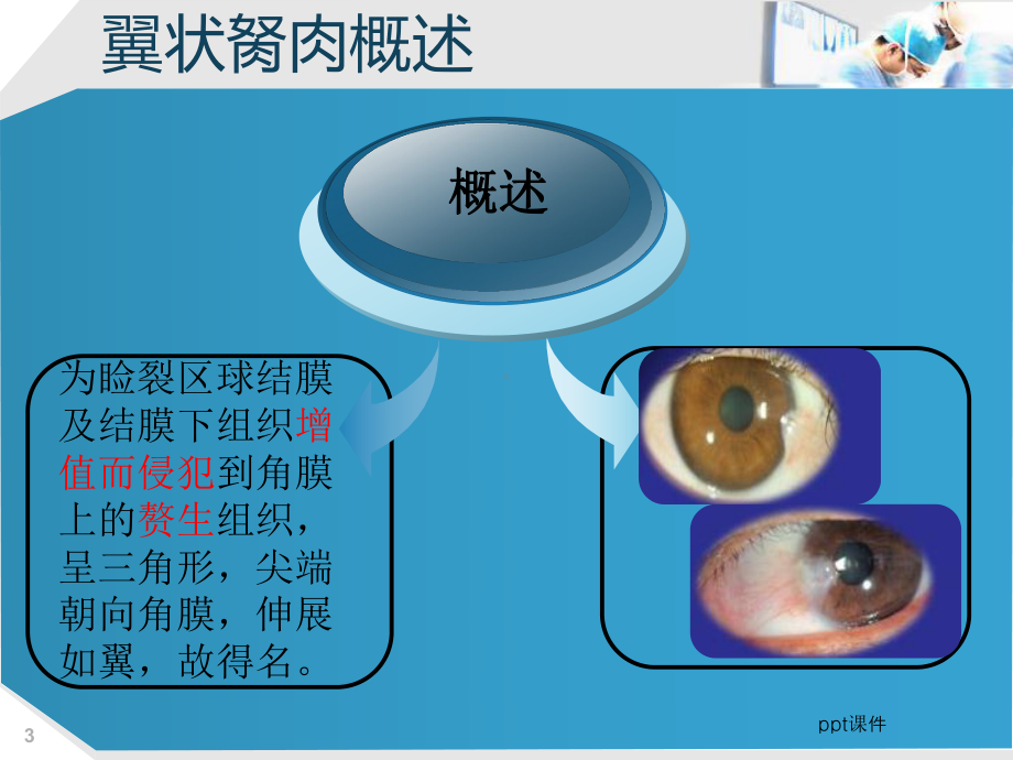 眼科翼状胬肉课件.ppt_第3页