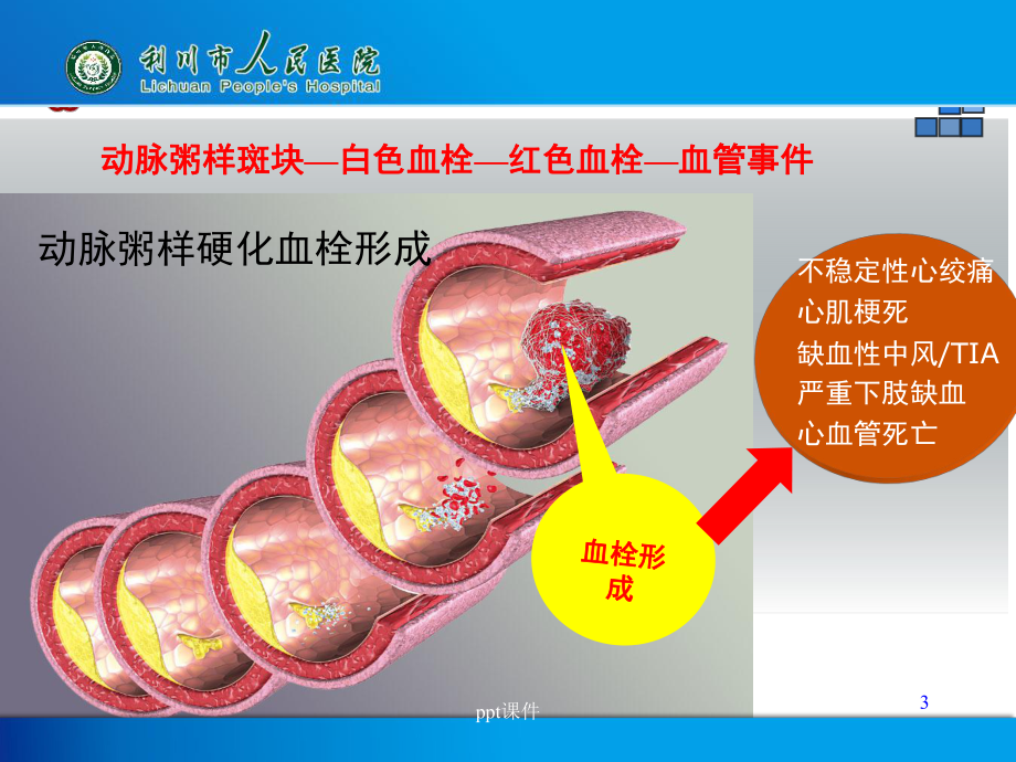 心源性卒中的抗栓治疗课件.ppt_第3页