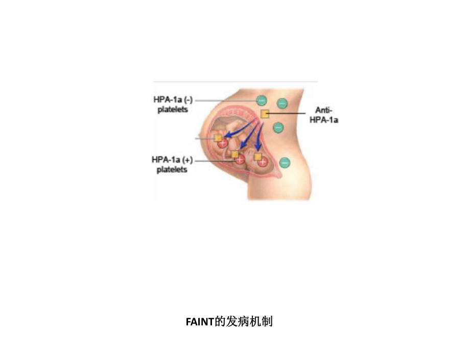 同种免疫性血小板减少症诊断新方法-广州血液中心课件.ppt_第3页