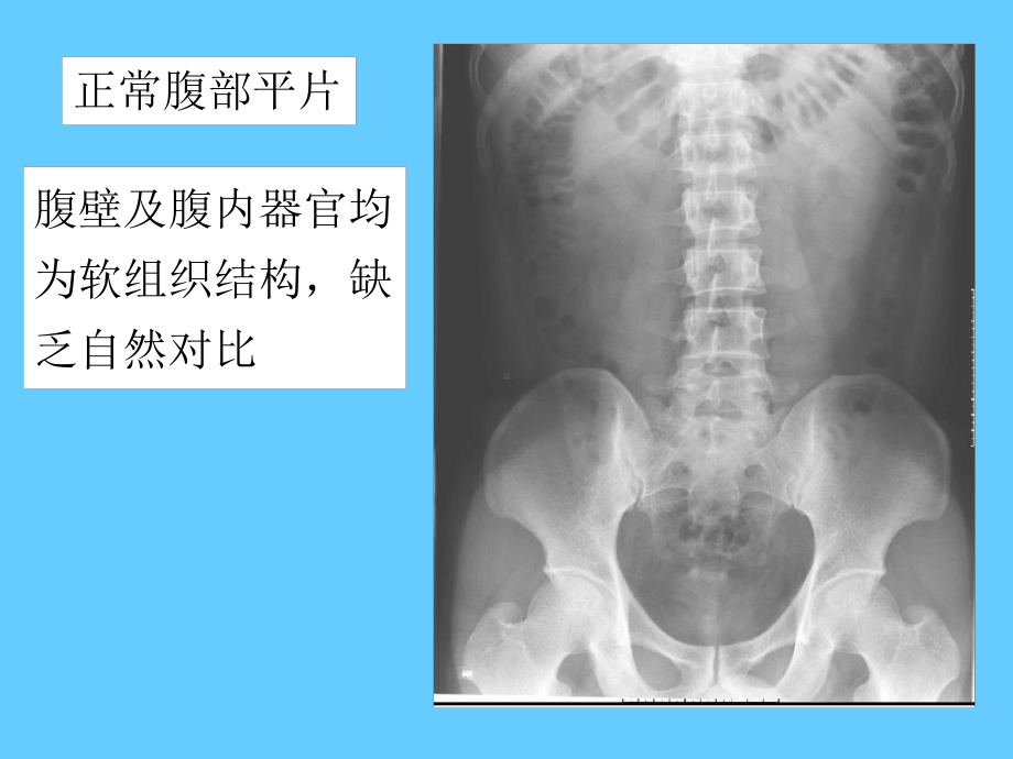 肠梗阻X线表现课件.ppt_第3页