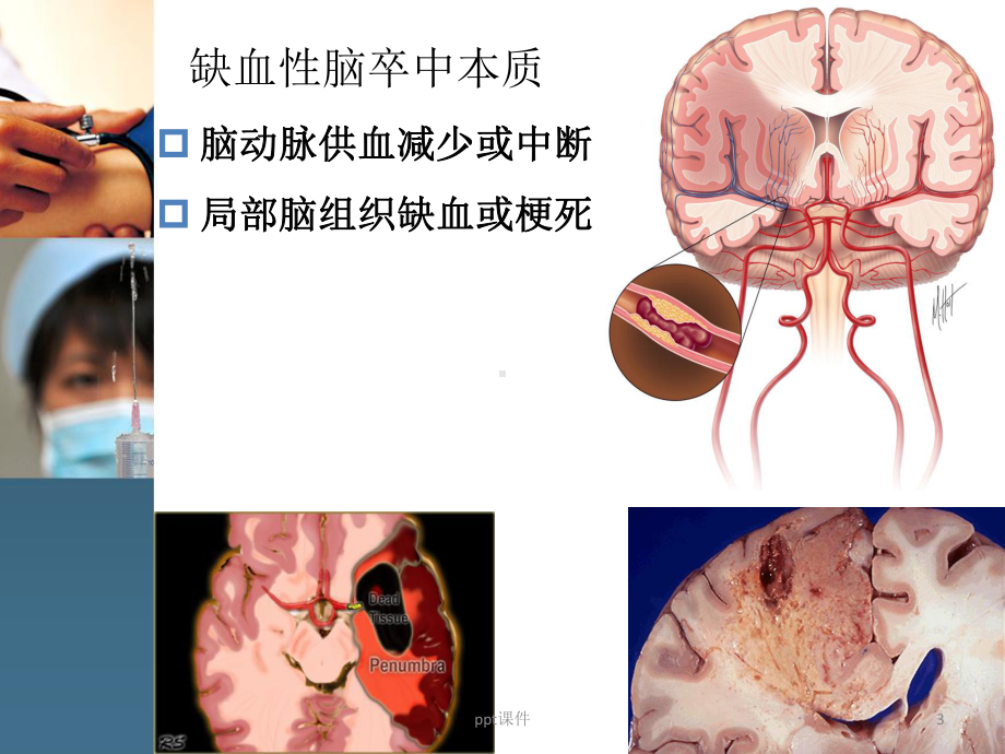 机械取栓术治疗脑卒中课件.ppt_第3页