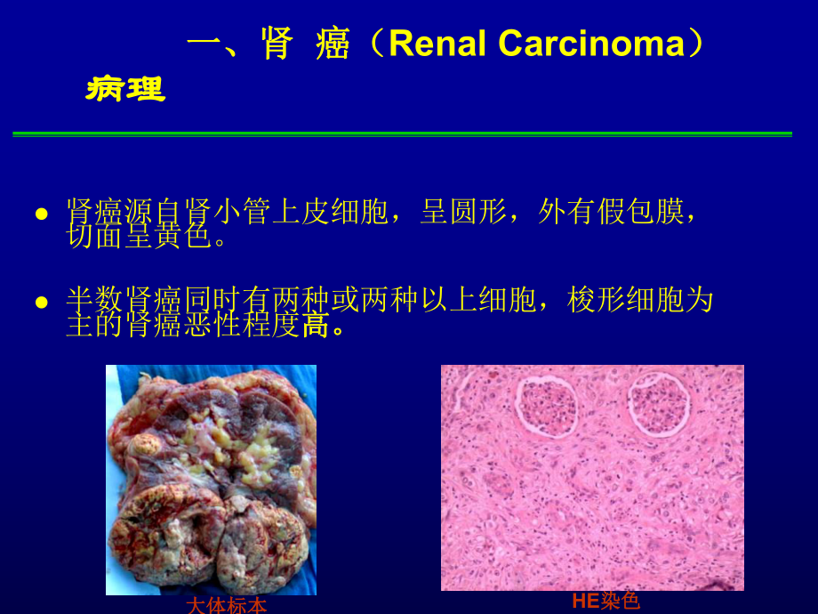 外科学泌尿男生殖系统肿瘤课件.ppt_第3页