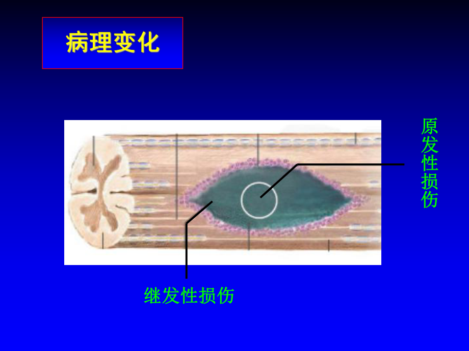 脊髓损伤的治疗及研究进展课件.ppt_第3页