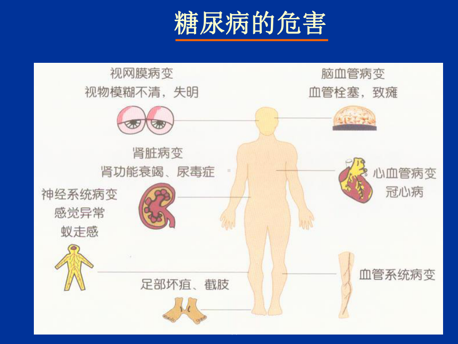 糖尿病之重点3糖尿病眼部并发症课件.ppt_第2页