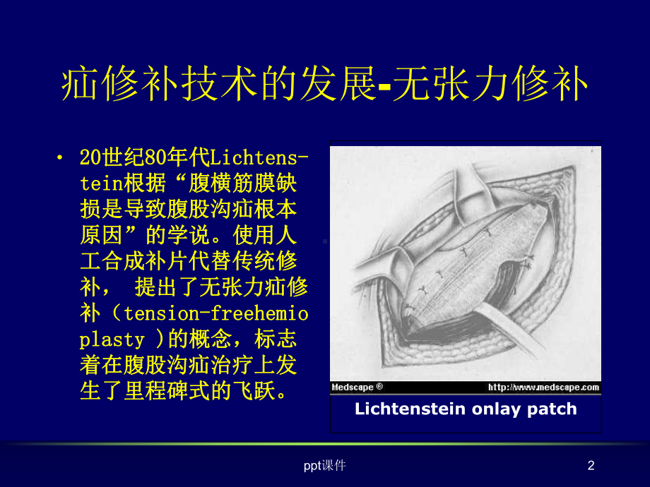 腹膜前间隙疝修补术课件.ppt_第2页