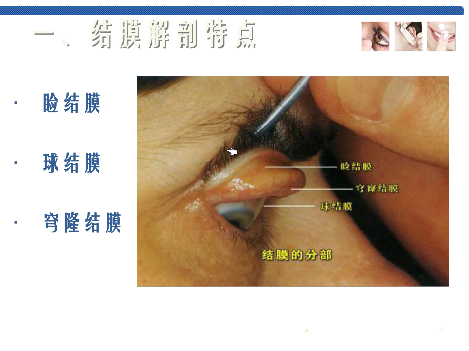 五官科学第三章-眼科常见疾病2结膜病一结膜炎课件.ppt_第3页