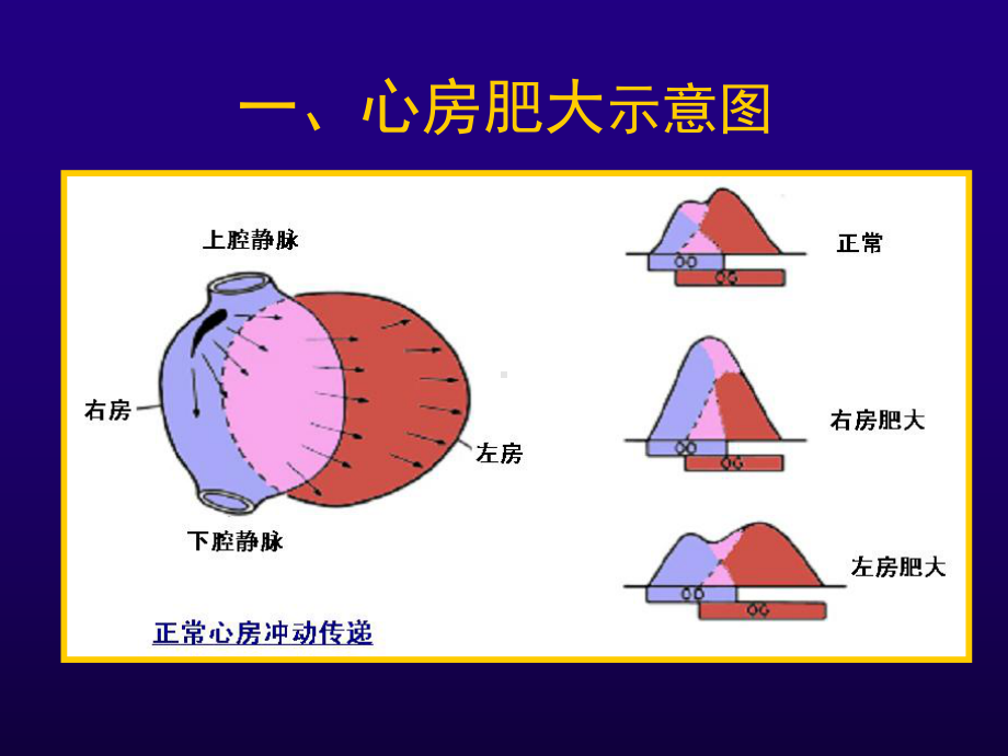 双室肥大心房与心室肥大课件.ppt_第3页