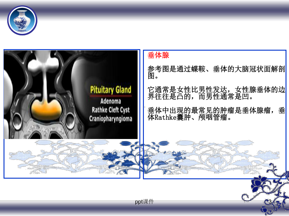 垂体及周围解剖及疾病课件.ppt_第3页