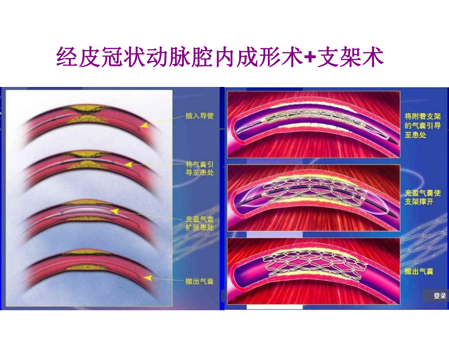 药物洗脱支架课件.ppt_第2页