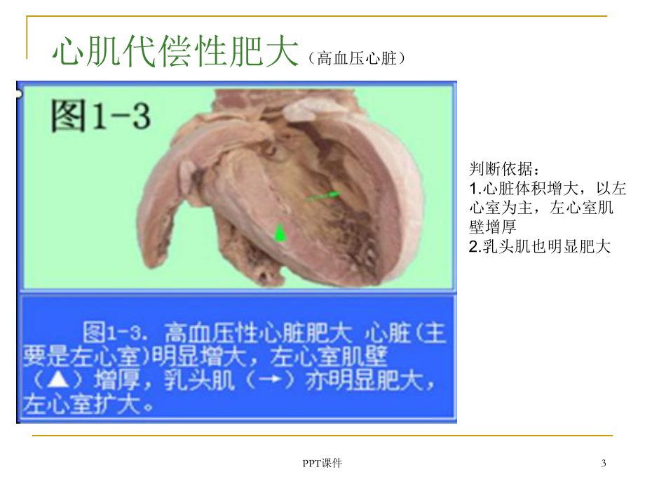 病理学大体标本课件.ppt_第3页