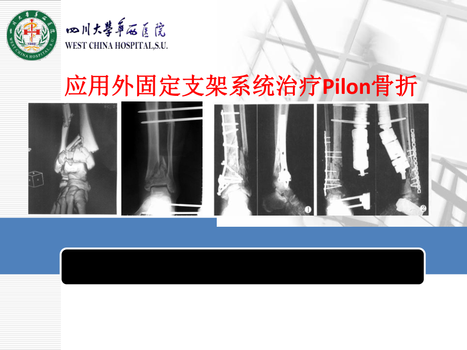 应用外固定支架系统治疗Pilon骨折课件.pptx_第1页