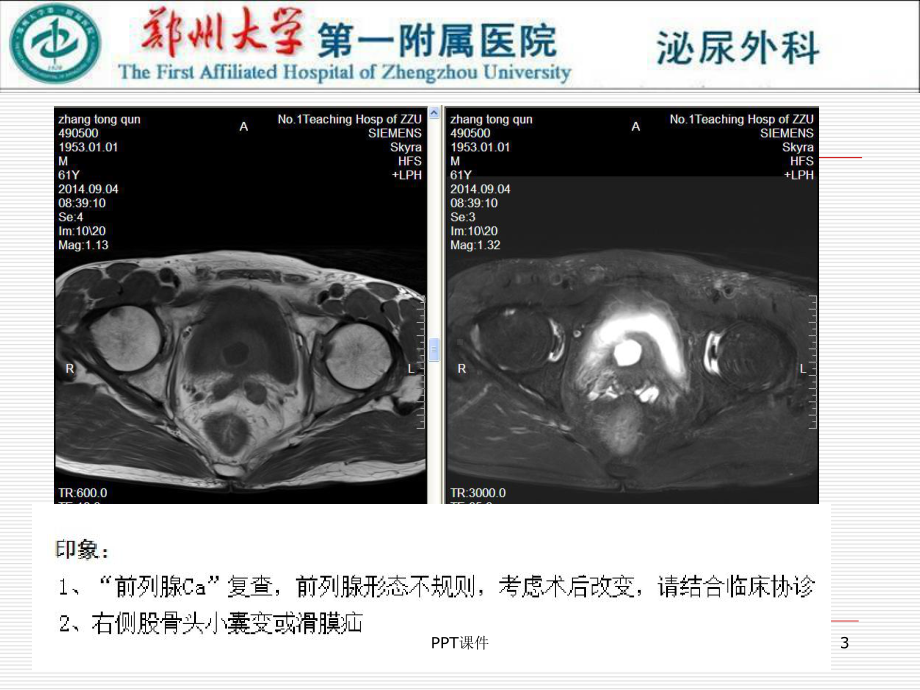 前列腺癌病例讨论课件.ppt_第3页