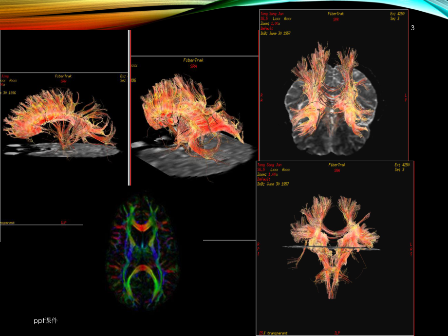 磁共振弥散张量成像讲解课件.ppt_第3页