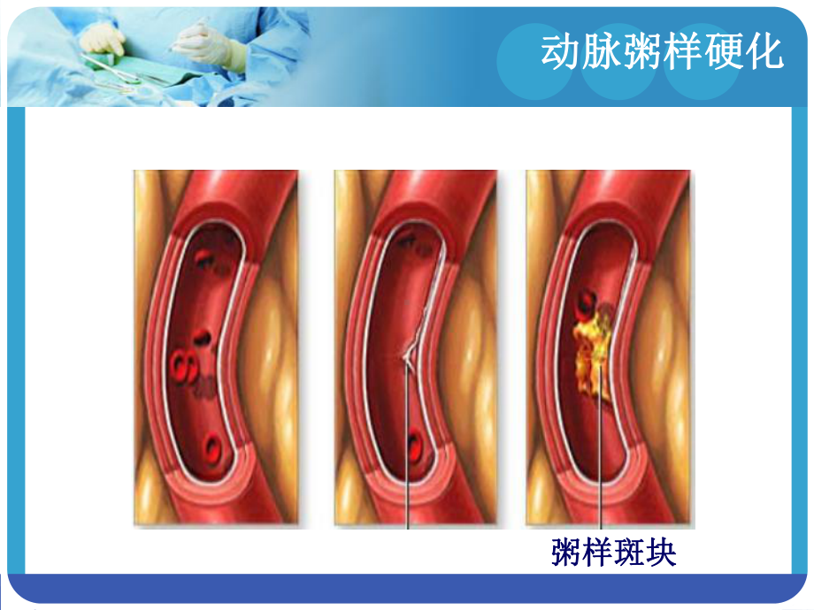 冠心病的护理相关知识课件.pptx_第2页