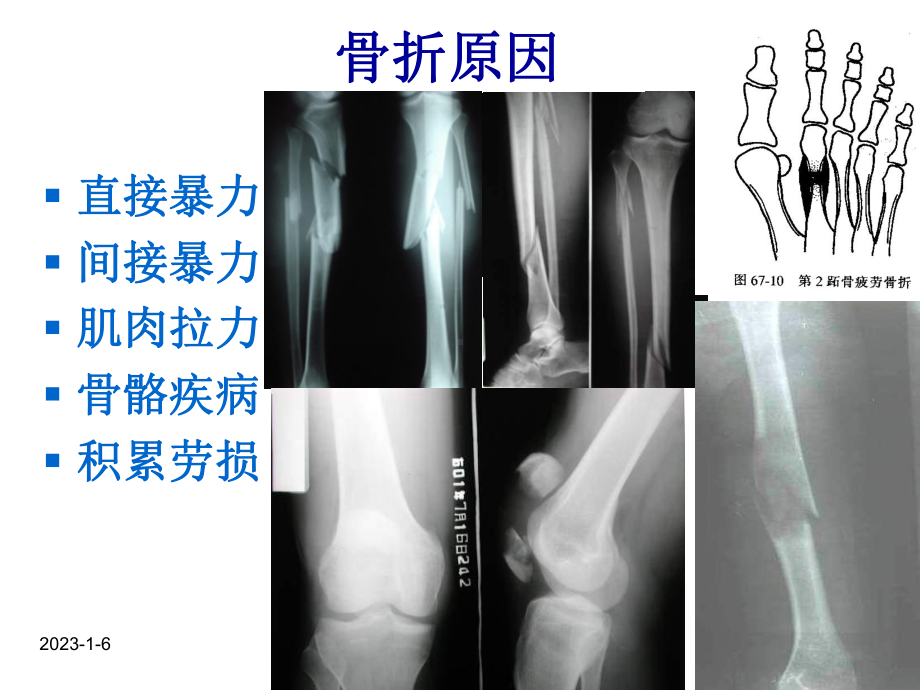 人卫第九版骨科课件-骨折概论.ppt_第2页