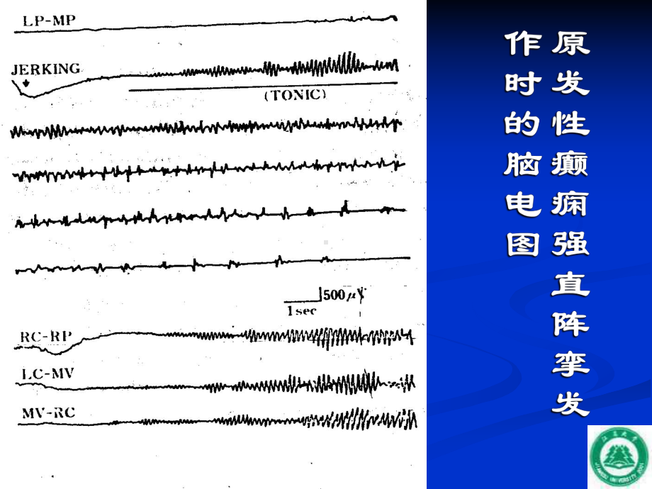 第十五章抗癫痫药和抗惊厥药课件.ppt_第3页