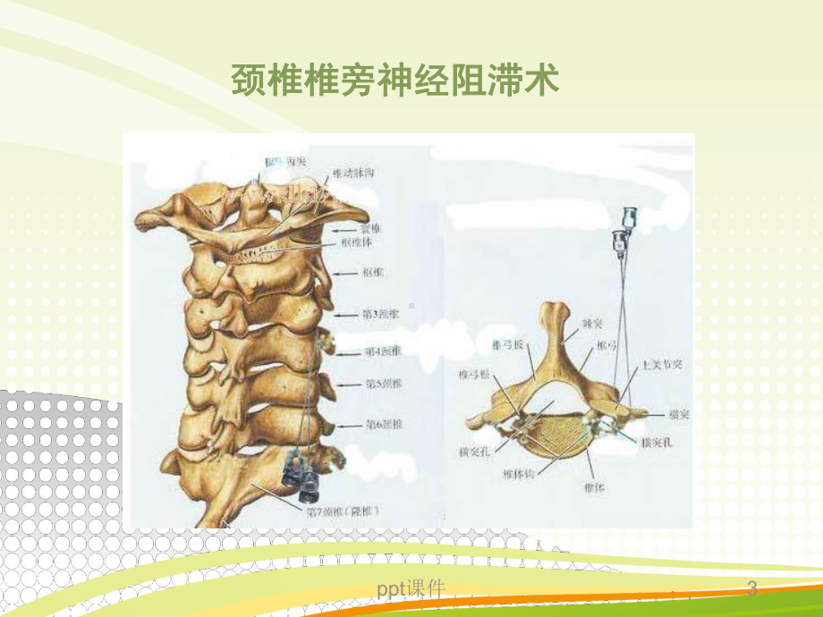 椎旁神经阻滞课件.ppt_第3页