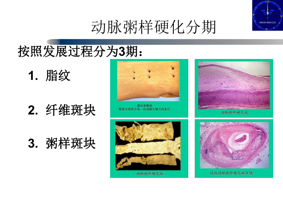 脑动脉硬化及其检测课件.ppt_第3页