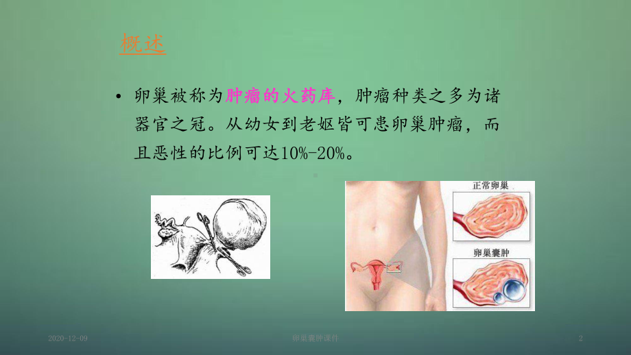 卵巢囊肿课件(课件).ppt_第2页