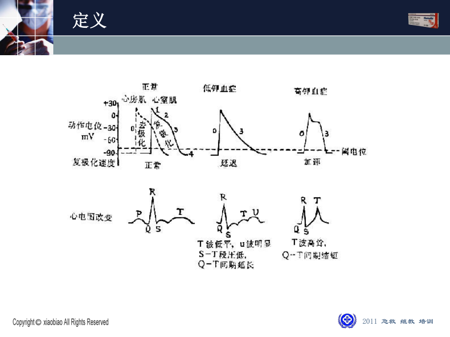 高钾血症紧急救治课件.ppt_第3页