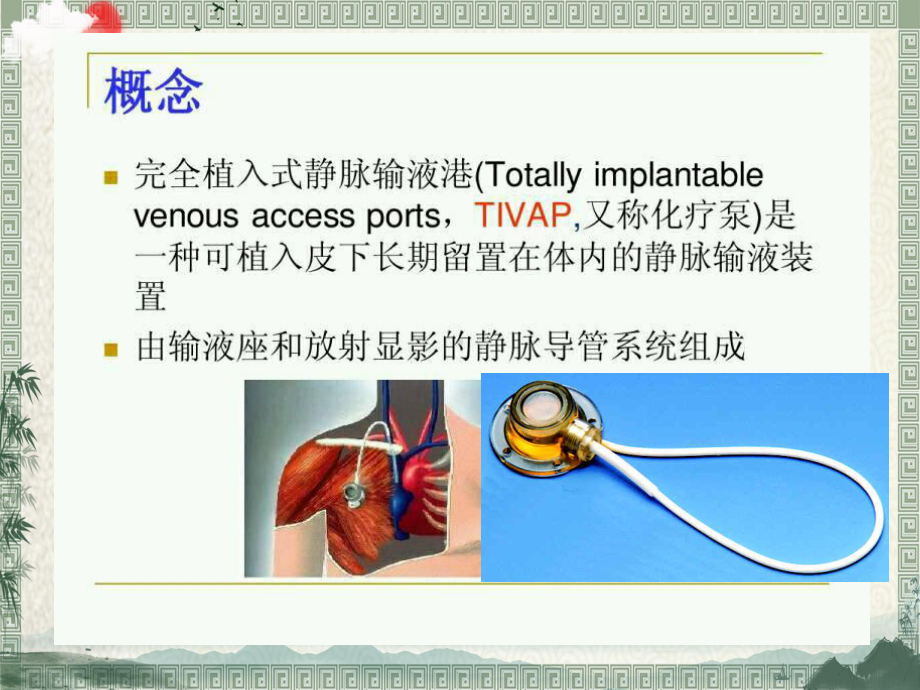 输液港及护理相关知识课件.pptx_第3页