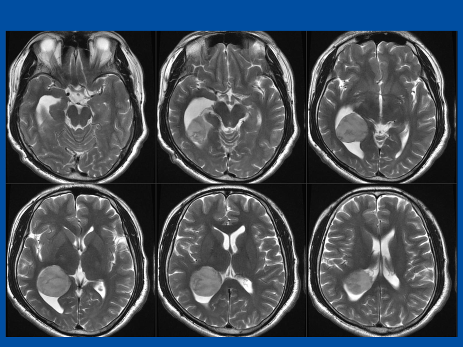 脑室海绵状血管瘤课件.ppt_第2页