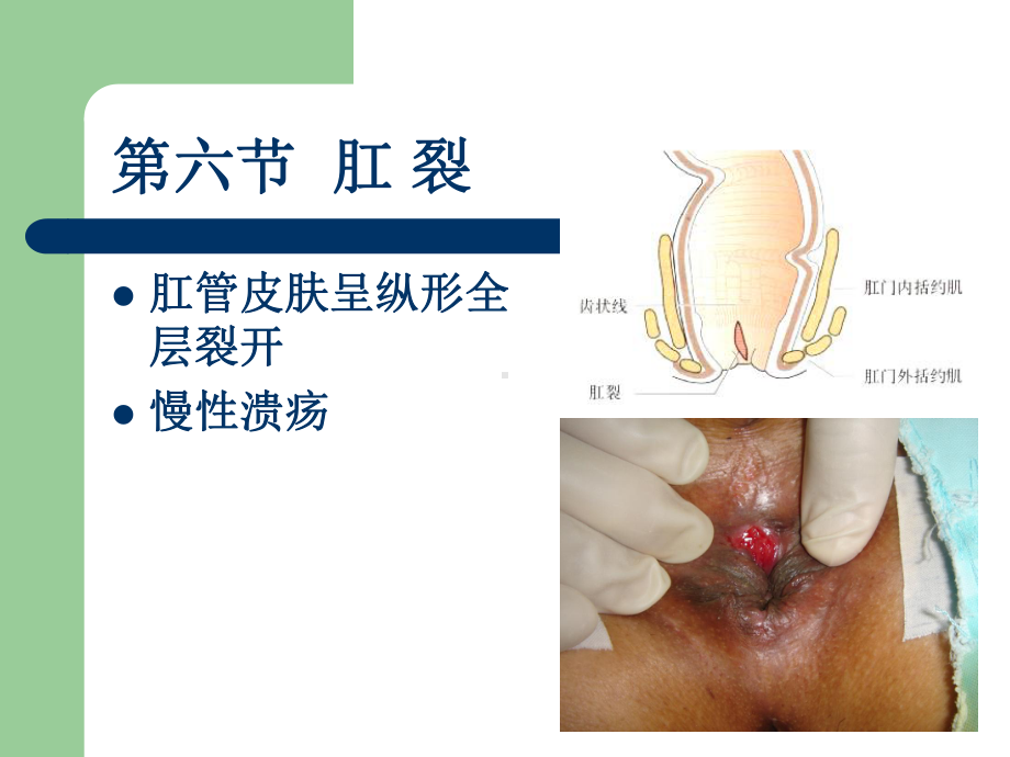 中医外科学-3肛裂课件.ppt_第1页