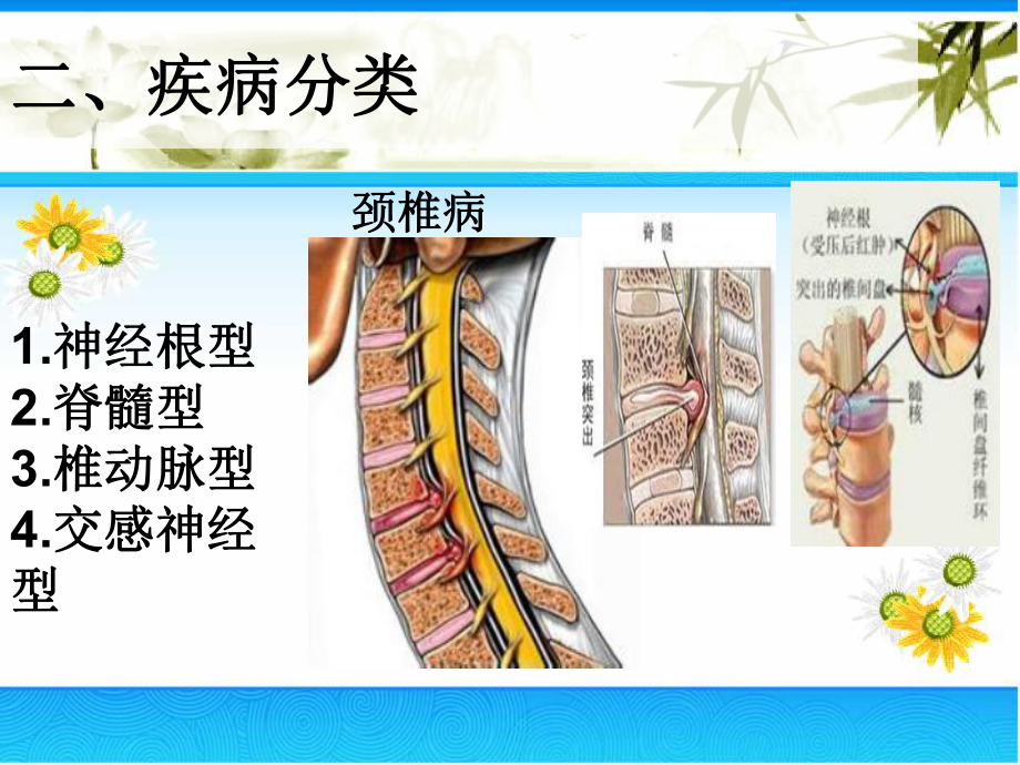 项痹护理培训课件.pptx_第3页