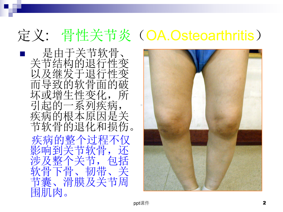 膝关节骨性关节炎的中医治疗课件.ppt_第2页