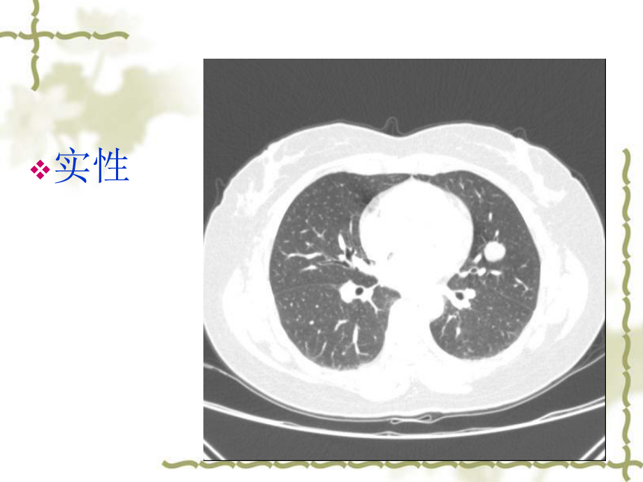 肺孤立性结节讲课-九〇三医院课件.ppt_第3页