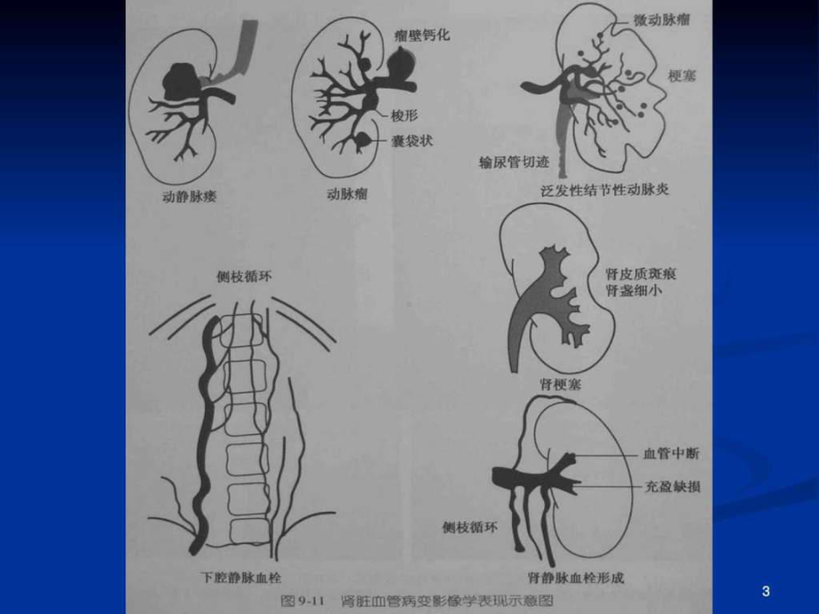 最新(下)肾脏CTA影像诊断-课件.ppt_第2页